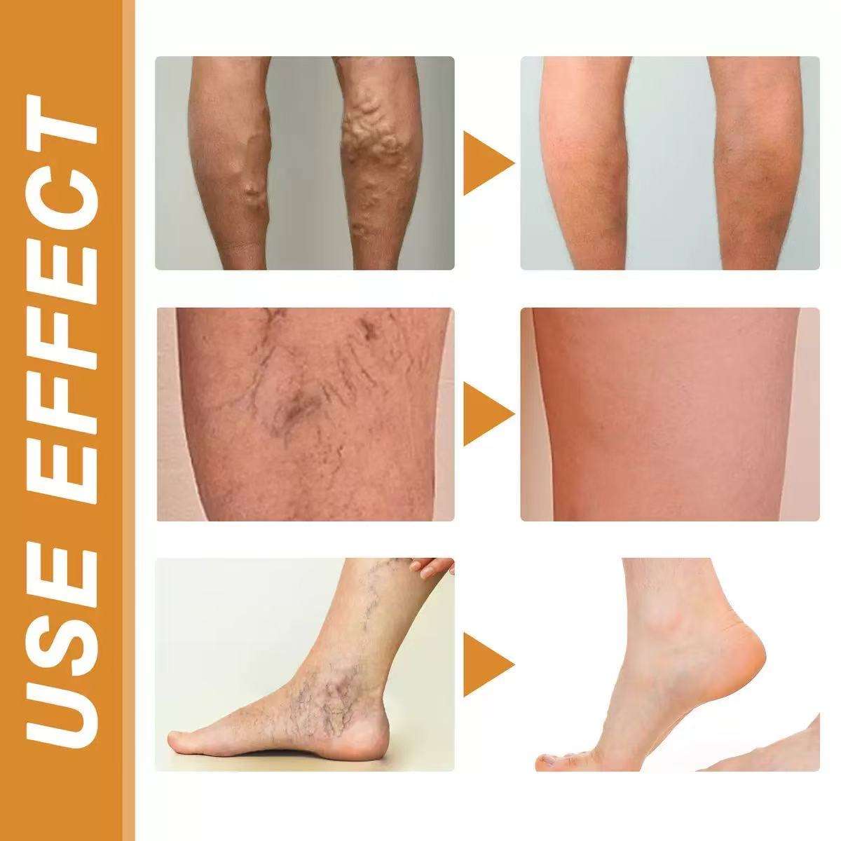 Varicose Veins Health Care Paste